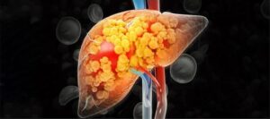 Why Is Fatty Liver Becoming Common in Slim Indian Adults?